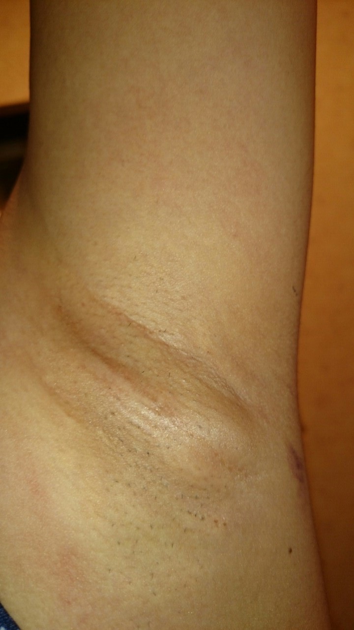 ミラドライ体験記その001_20代女性・エステサロン勤務・ニオイと汗でお悩みの患者様の症例│東京プラチナムクリニック